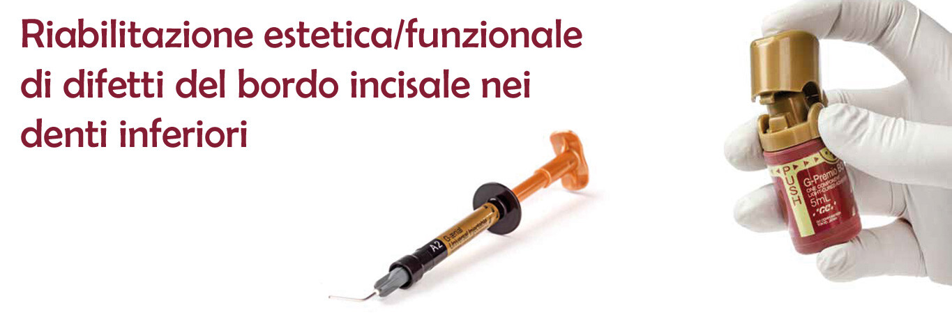 Riabilitazione estetica/funzionale di difetti del bordo incisale nei denti inferiori