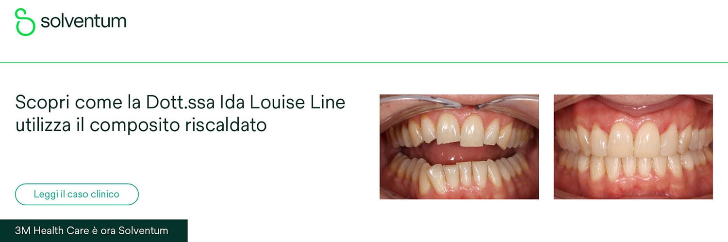 L'effetto del composito riscaldato nella pratica clinica: caso clinico di restauro composito dentale