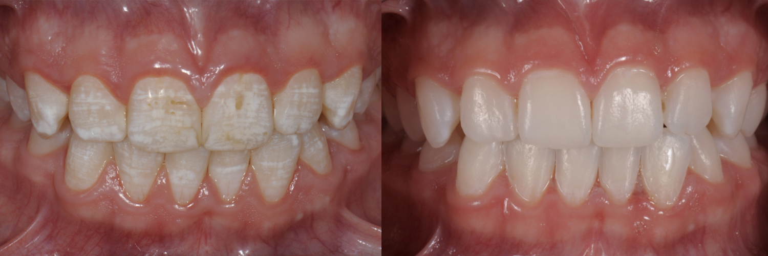 Trattamento estetico della fluorosi dentale: case-report su tecniche minimamente invasive