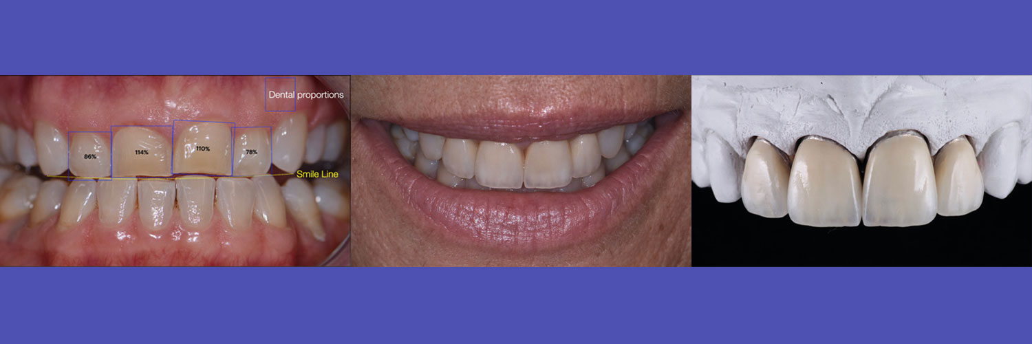 Il mock-up Virtuale nel trattamento odontoiatrico del Gummy-Smile, l’immagine che vale più di mille parole.