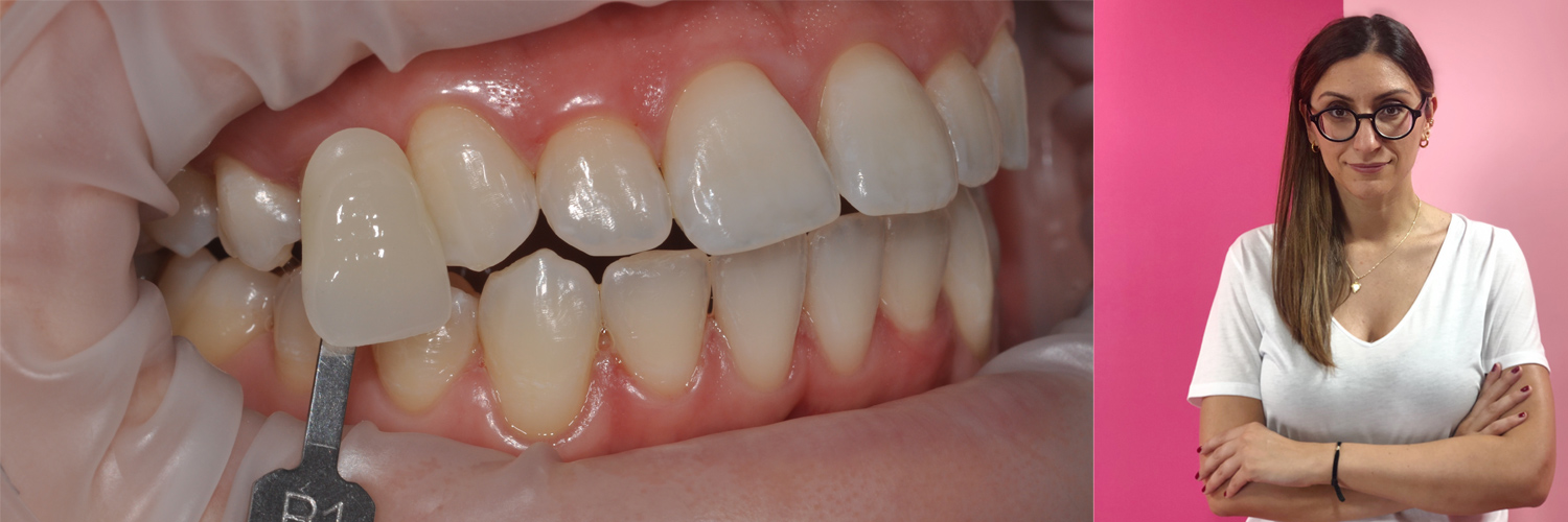 Sbiancamento dentale professionale: tu da che parte stai?