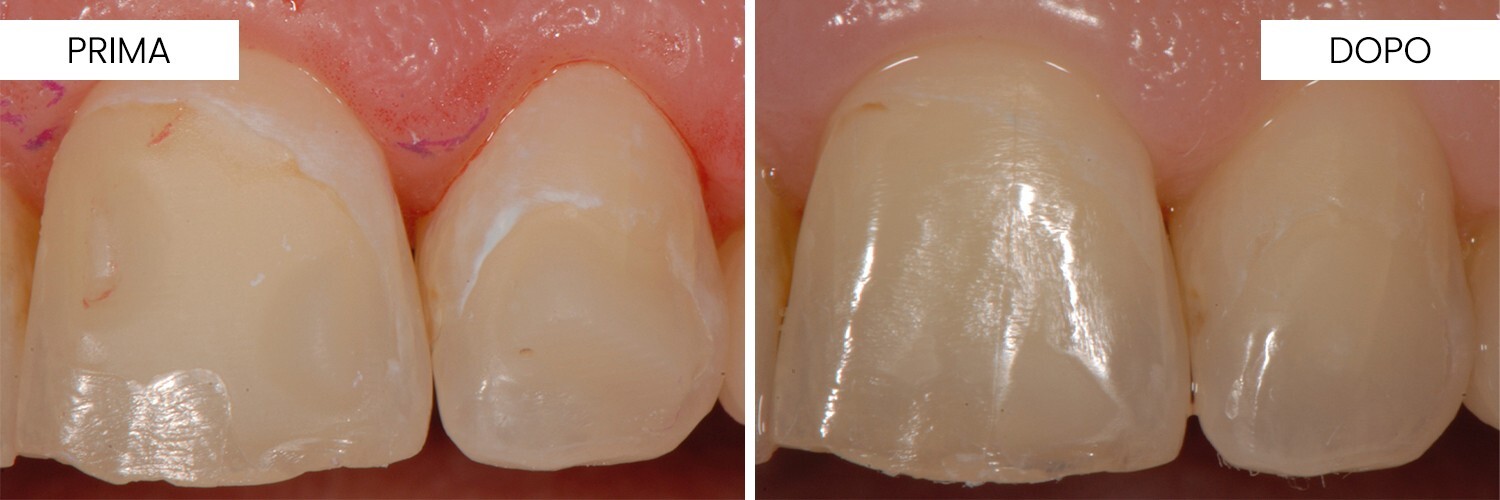 Un approccio clinico integrato per l’arresto e la rigenerazione delle lesioni cariose iniziali: peptidi biomimetici e ortodonzia con allineatori